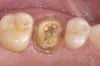 Figure 2  Crown and temporary removed.