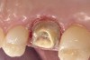 Figure 4  Gingivoplasty completed. Note the quality of the gingival retraction and the dryness of the field.