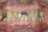 Figure 3  High risk caries patient with low activity.
