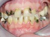 Figure 4  Extreme caries risk patient with high activity.