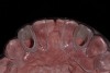 Figure 6  Occlusal view, TempStent II Surgical Guide.