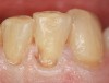 Figure 2  Preparation following caries removal.