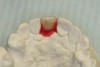 Figure  14   A tooth from an extra denture set that fits the space can be molded into position by using red rope wax.