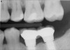 Figure 12  Horizontal spacing needed between the natural tooth and the implants and between the adjacent implants.