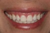 Fig 11. Dependent upon high-quality impressions, provisional restorations are essential components of esthetic restorative cases.