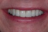 Fig 8. The lip line of this patient required deeper implant placement in the partially edentulous area.