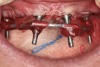 Fig 5. Impression-taking with splinted impression copings with autopolymerizing resin and wire.