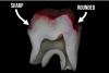 Fig 4. Extracted molar prepared for crown with cured layer of universal adhesive applied and stained pink.