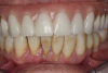 Fig 6. Periodontitis, mandibular dentition; pain and infection were evident.