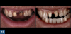 Fig 13. Left panel: Darkened tooth stumpfs and root structure may impact the esthetics of any translucent ceramic restorations placed over them. Right panel: Internal bleaching has been shown to be an effective means of producing a more favorable substrate color that favors the achievement of an optimal esthetic final result.
