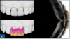 Fig 14. The final stumpf shade should ultimately be guided by the ceramist’s knowledge of core materials (top left panel) and layering porcelain for masking the underlying tooth structure (bottom left panel).