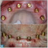 Fig 8. Conventional Locator attachments attached to the maxillary implants (top panel) and mandibular implants (bottom panel).