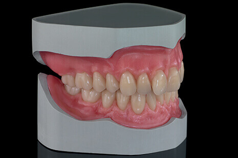 Digital Dentures: Options, Workflows and Esthetic Outcomes