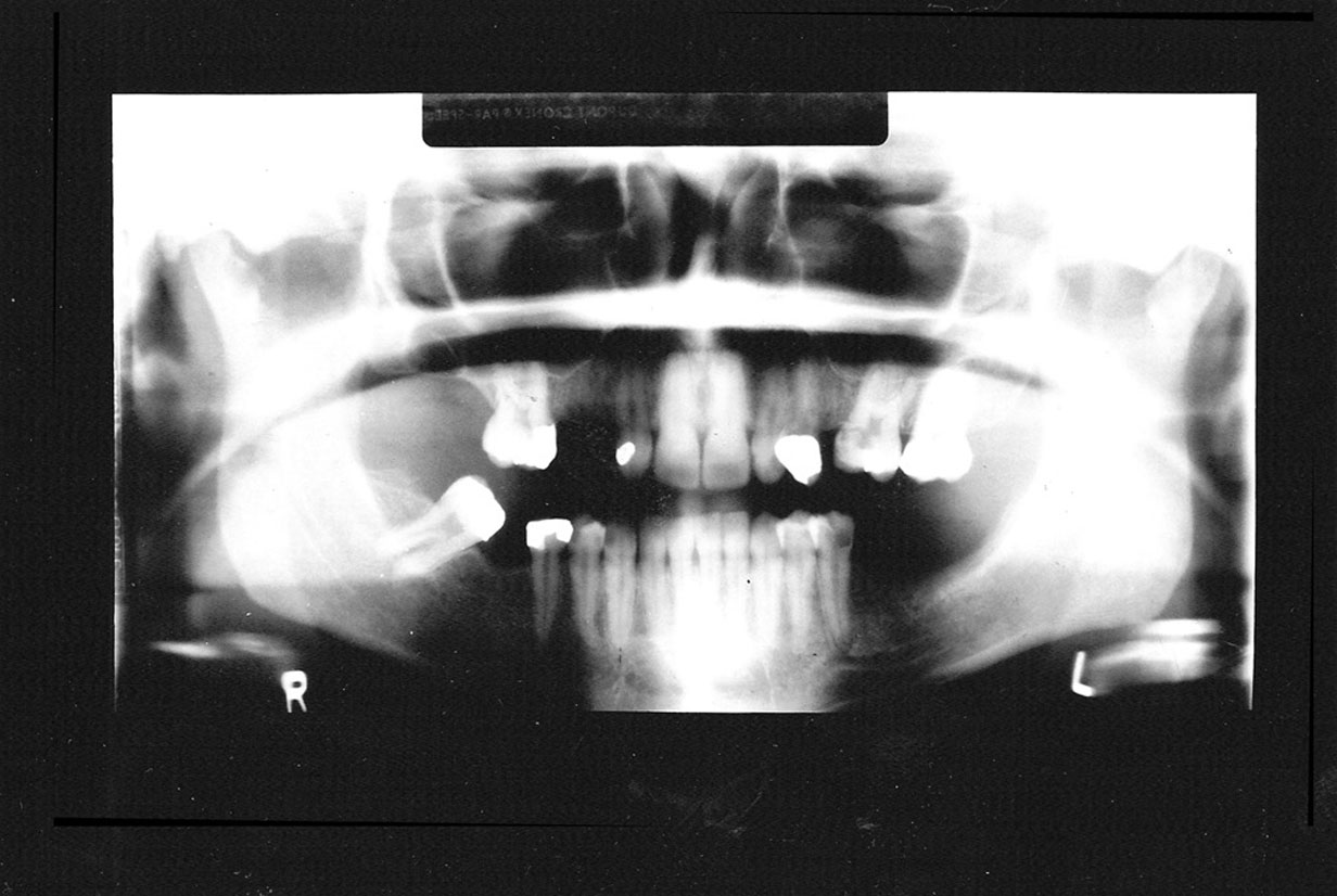 bogstaveligt talt flertal tabe Dental Radiographic Pitfalls and Errors | American Dental Assistants  Association