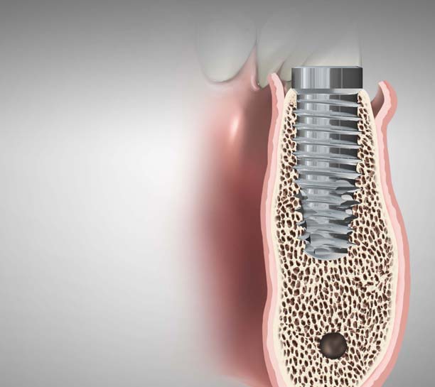 Innovations for Minimally Invasive Esthetic Implant Surgery eBook Thumbnail