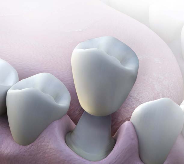 Protocol Considerations for Achieving Predictable Crown and Veneer Restorations eBook Thumbnail
