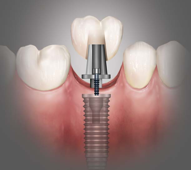 Demystifying Single-Tooth Implant Placement and Restoration eBook Thumbnail