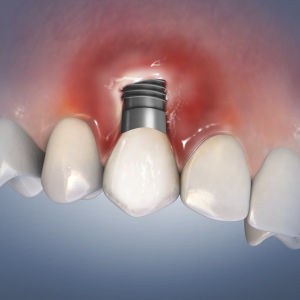 Understanding Peri-Implant Diseases: Etiology, Prevention, and Treatment eBook Thumbnail