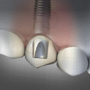 The Importance of Using Authentic Implant Parts eBook Thumbnail
