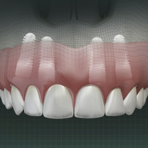 Removable Prosthetic Options for Implant Dentistry eBook Thumbnail