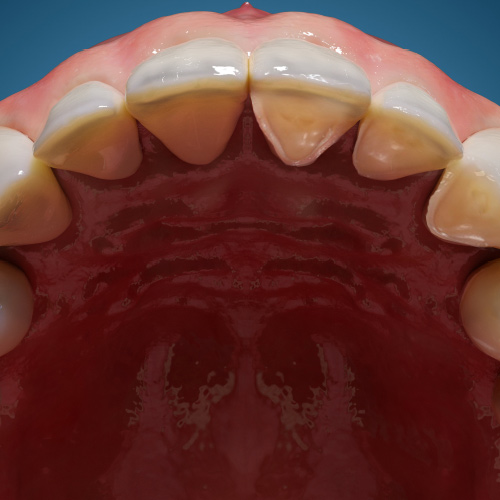 Dental Erosion: Definition, Causes, and Management eBook Thumbnail