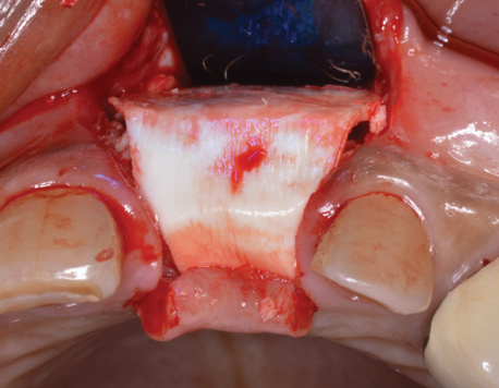 Exploring the Benefits of Non-Invasive Reverse Torque Technique for Dental Implant  Removal, Exploring the Benefits of Non-Invasive Reverse Torque Technique  for Dental Implant Removal - Kazemi Oral Surgery