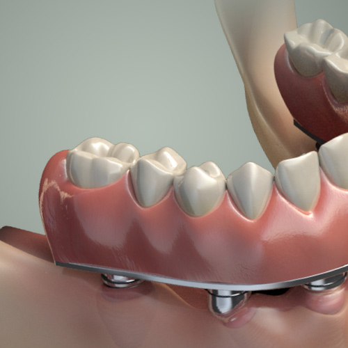 Cosmetic Implant Dentistry: Platform and Abutment Selection Considerations eBook Thumbnail