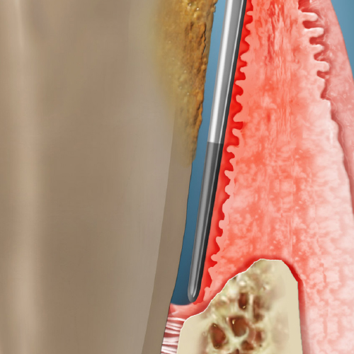 Review of Updated Periodontal Classifications for Personalized Patient Care eBook Thumbnail