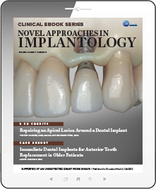 Novel Approaches in Implantology eBook Thumbnail