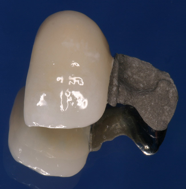 monster salami Capillaries Single-Tooth Replacement in the Esthetic Zone: Treatment Outcome  Perspective | Kerr University Online Learning Center