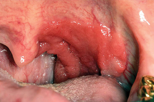papillomavírus uvula