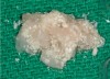 Figure 4  rhBMP-2/ACS plus mineralized allograft.