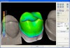 Figure 12  Reduction of the full-contour design to create the zirconia substructure with customized support for the CAD/CAM veneer layer.