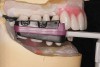 Figure 7  Filou 28 Denture set-up system: maxillary and mandibular teeth-jig assembly. Teeth are ready to seal in seal/wax to underlying denture transitional acrylic bases.