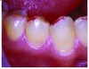 Figures 2 and 3. Abfraction lesions present on teeth with heavy indicator
markings. The marks indicate large contact areas present on the
cusp inclinations rather than the ideal small contact points on the cusp
tips. Reprinted with permission from Dr. Robert Palmer, DDS.