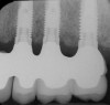Figure 15  Radiographs of edentulous maxilla: dental implant fixed partial denture.