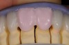 Figure 8  A full build-up with dentin color and silicone index.