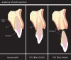 Figure 1  Anatomy of tooth avulsion. Note PDL cells remaining on root.