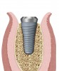 Figure 6  Placement of a tapered implant with a 4.8-mm apical diameter and a 6.5-mm restorative platform diameter, which begins to broaden subcrestally as it expands to the restorative platform diameter in an atrophic ridge, results in thinner residual buccal and lingual alveolar bone.