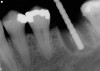 Figure 7  Following removal of a mandibular first molar an osteotomy was performed in the interradicular bone, a guide pin placed, and a radiograph taken.