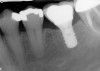 Figure 10  A radiograph taken 54 months after implant restoration demonstrates the stability of the crestal peri-implant bone.