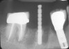 Figure 13  A radiograph of a guide pin in the prepared osteotomy.