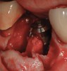 Figure 15  Another view of the implant in the interradicular bone. Note that the mesial and distal aspects of the interradicular septum have been lost. The implant attained primary stability from the buccal and lingual aspects of the interradicular bone.
