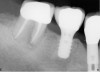 Figure 16  A radiograph of the restored implant taken after more than 7 years in function demonstrates stable peri-implant crestal bone levels.