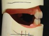 Figure 13  The right side of the maxillary and mandibular anterior dentition.
