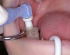 Figure 2  Occlusal surface being cleaned with pumice paste with a prophylaxis cup.