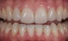 Figure 6  Two-year postoperative image of very conservative Category 1 bonded porcelain restorations.