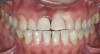 Figure 11  Preoperative photograph of a case in which the patient refused surgery and orthodontics. The treatment goal was to do minimal preparation and use a tough material due to general medium-to-high risk in every area—obtaining a seal was possible.