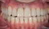 Figure 12  Postoperative photograph with bonded full-contour restorations in place on the posterior teeth and incisally layered anterior teeth.