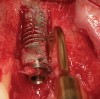 Figure 3  (Case 1) Removal of implant was accomplished using piezo-surgery in order to maintain the lingual plate. Note that trephines are not recommended for this procedure.